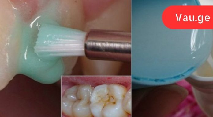 ეფექტური კბილების გათეთრება სახლში: უკეთესია, ვიდრე პროფესიონალური გაწმენდა!