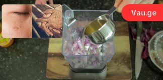 ამერიკელმა ექიმმა მოგვაწოდა ინფორმაცია! ამ ორი ნივთიერების საშუალება ძალიან სწრაფად ათეთრებს ასაკობრივ ლაქებს.