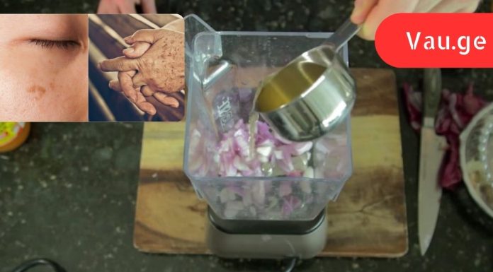 ამერიკელმა ექიმმა მოგვაწოდა ინფორმაცია! ამ ორი ნივთიერების საშუალება ძალიან სწრაფად ათეთრებს ასაკობრივ ლაქებს.