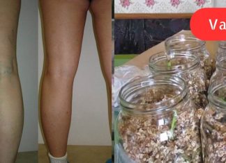 ვარიკოზული ვენების ეფექტური წამალი ყველა აფთიაქშია! მაგრამ ცოტამ თუ იცის ეს.