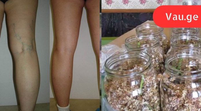 ვარიკოზული ვენების ეფექტური წამალი ყველა აფთიაქშია! მაგრამ ცოტამ თუ იცის ეს.