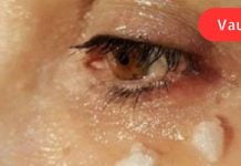 რა მოხდება 5 წუთის შემდეგ, თუ ქოქოსის ზეთს თვალის მიდამოში წაისვით?