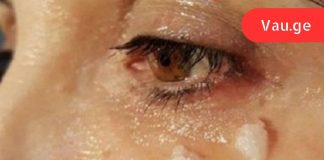 რა მოხდება 5 წუთის შემდეგ, თუ ქოქოსის ზეთს თვალის მიდამოში წაისვით?