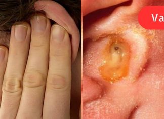 დაემშვიდობეთ ყურის ინფექციებს! აი, როგორ მარტივად მოიშოროთ პრობლემას მხოლოდ 1 დღეში.