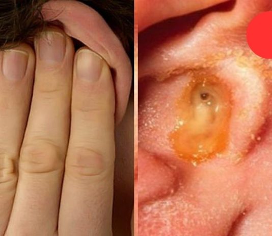 დაემშვიდობეთ ყურის ინფექციებს! აი, როგორ მარტივად მოიშოროთ პრობლემას მხოლოდ 1 დღეში.