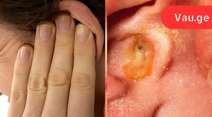 დაემშვიდობეთ ყურის ინფექციებს! აი, როგორ მარტივად მოიშოროთ პრობლემას მხოლოდ 1 დღეში.