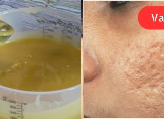 აკნეს ნიშნები, ნაწიბურები და ასაკობრივი ლაქები: ბუნებრივი სახლის საშუალება ყველაფერს წაშლის სახიდან!