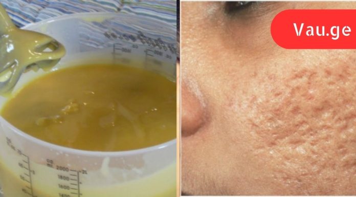 აკნეს ნიშნები, ნაწიბურები და ასაკობრივი ლაქები: ბუნებრივი სახლის საშუალება ყველაფერს წაშლის სახიდან!