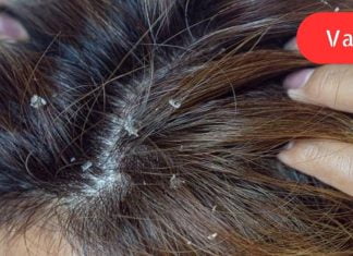 როგორ სწრაფად მოვიშოროთ ქერტლი: 8 ბუნებრივი საშუალება, რომელიც თქვენს თმას ყოფილ სილამაზეს დაუბრუნებს!