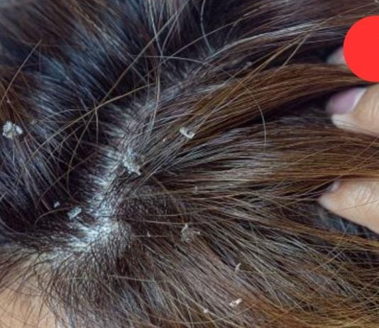 როგორ სწრაფად მოვიშოროთ ქერტლი: 8 ბუნებრივი საშუალება, რომელიც თქვენს თმას ყოფილ სილამაზეს დაუბრუნებს!