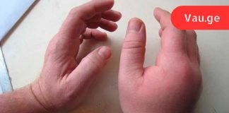 დაემშვიდობეთ სითხის შეკავებას, შეშუპებას და ჭარბ წონას მხოლოდ 1 კვირაში ამ საოცარი რეცეპტით