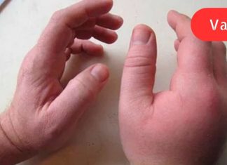 დაემშვიდობეთ სითხის შეკავებას, შეშუპებას და ჭარბ წონას მხოლოდ 1 კვირაში ამ საოცარი რეცეპტით