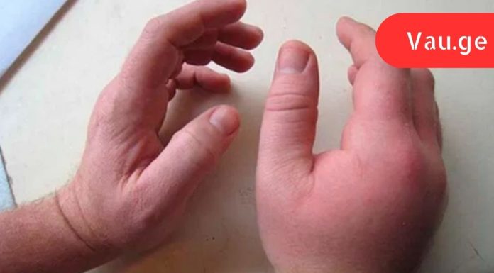 დაემშვიდობეთ სითხის შეკავებას, შეშუპებას და ჭარბ წონას მხოლოდ 1 კვირაში ამ საოცარი რეცეპტით