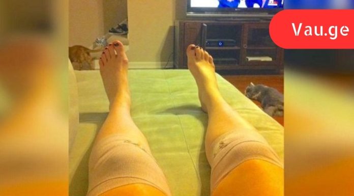 მან გაიკეთა ეს კომპრესი და მჭიდროდ შემოიხვია მუხლები! ერთი საათის შემდეგ მისი ცხოვრება შეიცვალა…