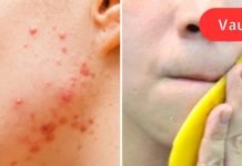 აი, რისი გაკეთება შეუძლია ბანანის ქერქს თქვენი კანისთვის: მე არასოდეს მინახავს უფრო ეფექტური საშუალება!