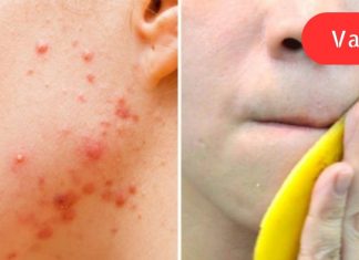 აი, რისი გაკეთება შეუძლია ბანანის ქერქს თქვენი კანისთვის: მე არასოდეს მინახავს უფრო ეფექტური საშუალება!