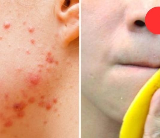 აი, რისი გაკეთება შეუძლია ბანანის ქერქს თქვენი კანისთვის: მე არასოდეს მინახავს უფრო ეფექტური საშუალება!