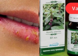 7 ხალხური მეთოდი, რომელიც დღის განმავლობაში ჰერპესის მოშორებაში დაგეხმარებათ!