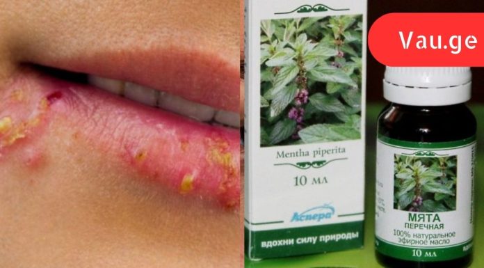 7 ხალხური მეთოდი, რომელიც დღის განმავლობაში ჰერპესის მოშორებაში დაგეხმარებათ!