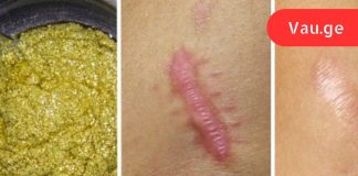 ეს ხალხური საშუალება სულ რაღაც 2 თვეში მოგიხსნით ნაწიბურებსა და სტრიებს!