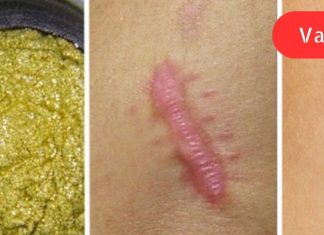 ეს ხალხური საშუალება სულ რაღაც 2 თვეში მოგიხსნით ნაწიბურებსა და სტრიებს!