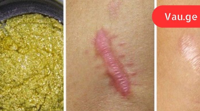 ეს ხალხური საშუალება სულ რაღაც 2 თვეში მოგიხსნით ნაწიბურებსა და სტრიებს!