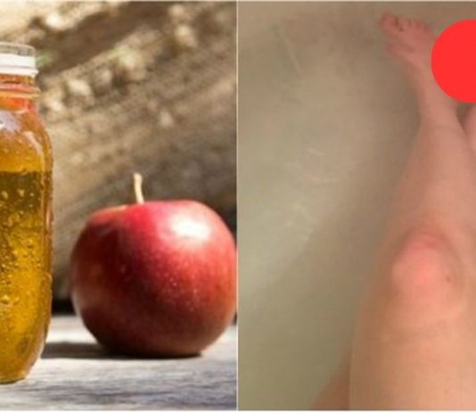 მან მიიღო აბაზანა და დაუმატა 500 მლ ვაშლის სიდრი ძმარი. 30 წუთის შემდეგ მისი კანი სასწაული იყო.