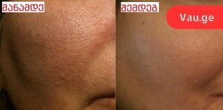 მხოლოდ ერთი ინგრედიენტით მოვიშორე გაფართოებული ფორები სახეზე! სასწრაფოდ უნდა სცადოთ თქვენც.