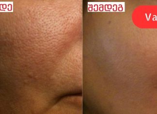 მხოლოდ ერთი ინგრედიენტით მოვიშორე გაფართოებული ფორები სახეზე! სასწრაფოდ უნდა სცადოთ თქვენც.