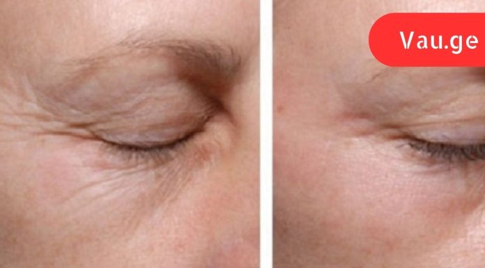 სახლში მომზადებული გელი თვალის ირგვლივ კანისთვის: ნატურალური ინგრედიენტები მოგაშორებთ ნაოჭებს!