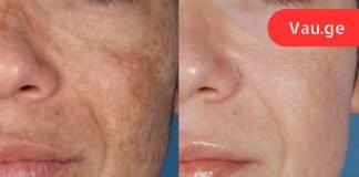 ამ ქალბატონმა როცა ხელებზე და სახეზე ყავისფერი ლაქები დაინახა, შეშინებული იყო! ესეთი იაფია მკურნალობა არასოდეს ყოფილა