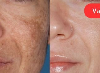 ამ ქალბატონმა როცა ხელებზე და სახეზე ყავისფერი ლაქები დაინახა, შეშინებული იყო! ესეთი იაფია მკურნალობა არასოდეს ყოფილა