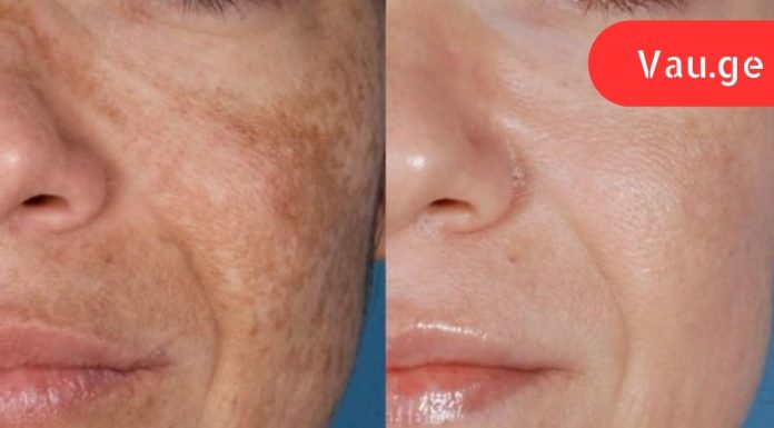 ამ ქალბატონმა როცა ხელებზე და სახეზე ყავისფერი ლაქები დაინახა, შეშინებული იყო! ესეთი იაფია მკურნალობა არასოდეს ყოფილა