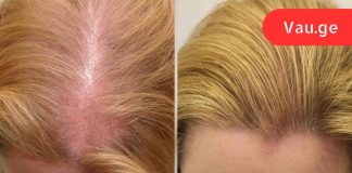 ამ ხრიკის წყალობით თმა ისე სწრაფად გამეზარდა ერთ თვეში თვალებს არ ვუჯერებდი