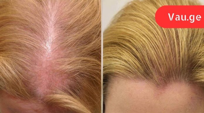 ამ ხრიკის წყალობით თმა ისე სწრაფად გამეზარდა ერთ თვეში თვალებს არ ვუჯერებდი