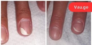 სწრაფი საშუალება ფრჩხილის სოკოს მოსარჩენად