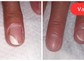 სწრაფი საშუალება ფრჩხილის სოკოს მოსარჩენად