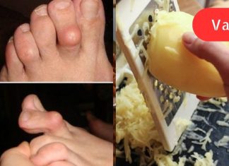 პირველადი დახმარების საშუალება რევმატოიდული ართრიტის დროს: ტკივილი გაქრა და ძვლები უფრო პატარაა!