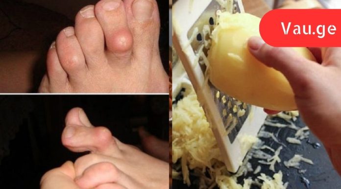 პირველადი დახმარების საშუალება რევმატოიდული ართრიტის დროს: ტკივილი გაქრა და ძვლები უფრო პატარაა!