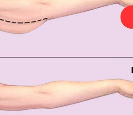 როგორ მოვიშოროთ ცხიმი ხელებიდან: 3 ეფექტური გზა.