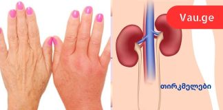 8 უტყუარი ნიშანი იმისა, რომ თქვენი თირკმელები წესრიგში არ არის.