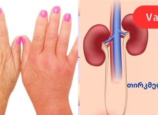 8 უტყუარი ნიშანი იმისა, რომ თქვენი თირკმელები წესრიგში არ არის.