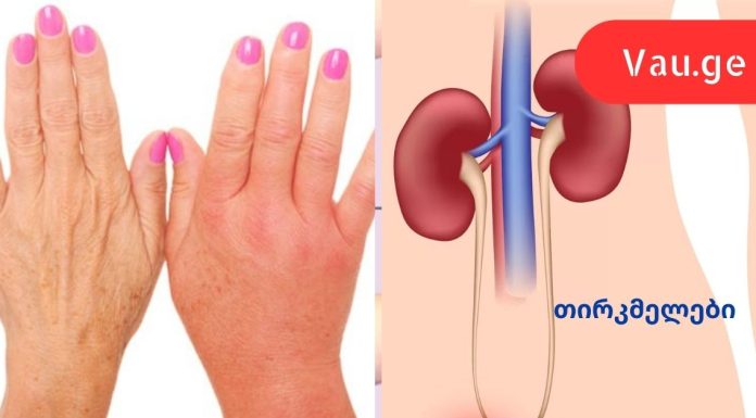 8 უტყუარი ნიშანი იმისა, რომ თქვენი თირკმელები წესრიგში არ არის.