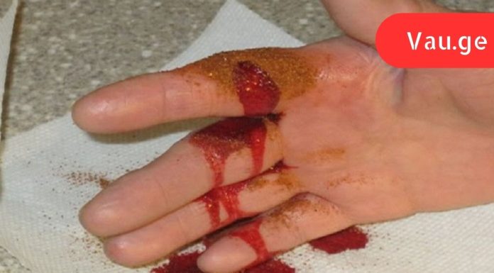 ხრიკი სისხლდენის შესაჩერებლად 10 წამში: უვნებელი მეთოდი!