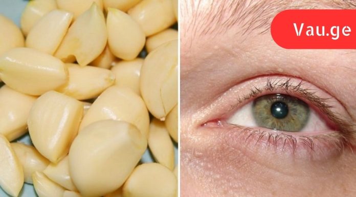 როგორ აღვადგინოთ მხედველობა ნიორით. არანაირი ოპერაციები!