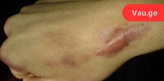 როგორ მოვიშოროთ ნაწიბურები ბუნებრივი საშუალებებით. ეს არის სიცოცხლის გადარჩენა ჩემი კანისთვის!