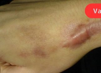 როგორ მოვიშოროთ ნაწიბურები ბუნებრივი საშუალებებით. ეს არის სიცოცხლის გადარჩენა ჩემი კანისთვის!