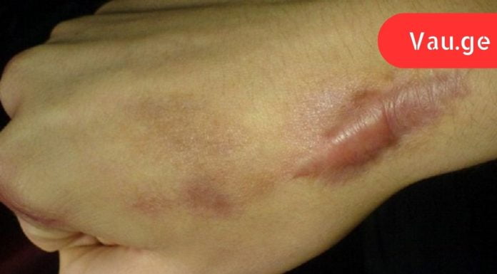 როგორ მოვიშოროთ ნაწიბურები ბუნებრივი საშუალებებით. ეს არის სიცოცხლის გადარჩენა ჩემი კანისთვის!