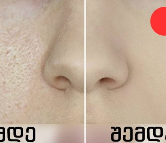 როგორ შევამციროთ გაფართოებული ფორები: 8 ეფექტური რეცეპტი!