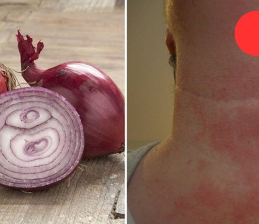 მან ღამით ხახვის კომპრესი გაიკეთა, დილით კი შედეგით უზომოდ გაკვირვებული დარჩა!